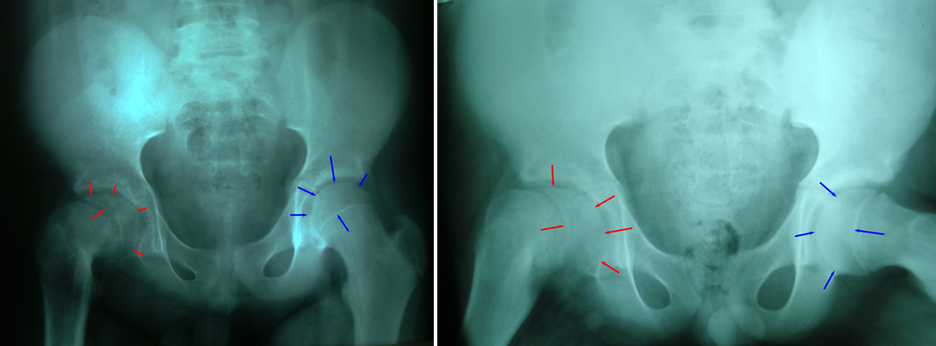 Radiografia com escorregamento epifisário proximal do fêmur ou epifisiólise femoral proximal no quadril em adolescente e criança. 