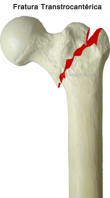 fratura trocantérica do fêmur deslocada e não deslocada por osteoporose