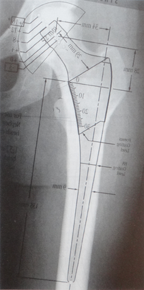 PQ_passo_passo01 Planejamento cirúrgico prótese de quadril tamanho modelo raio X  