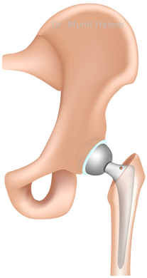 posição final da prótese de quadril após cirurgia estável 