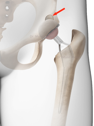 Osteólise ou perda de osso na bacia e fêmur depois de cirurgia de prótese de quadril, artroplastia do quadril Dr. Munif Hatem, complicação 