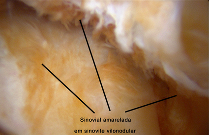 Cirurgia de artroscopia de quadril para sinovite vilonodular pigmentada 