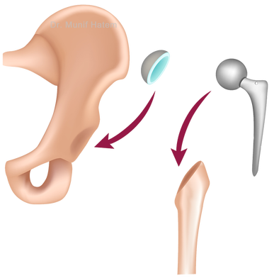 colocação da prótese de quadril, parte femoral e acetabular, passos da artroplastia