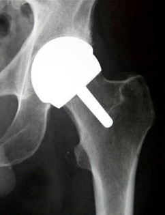 Radiografia ou Raio X de Prótese de resurfacing ou recapeamento do quadril