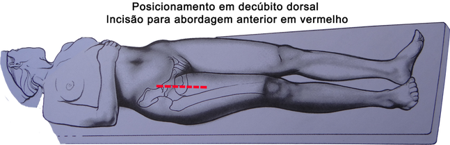 Abordagem anterior para cirurgia de prótese de quadril, corte na frente, cicatriz