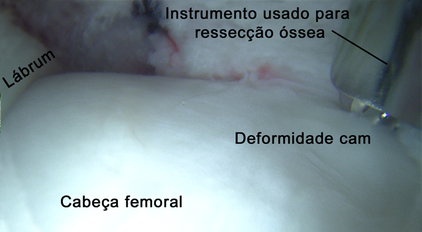 Imagem de vídeo-artroscopia do quadril com impacto fêmoro-acetabular tipo came 