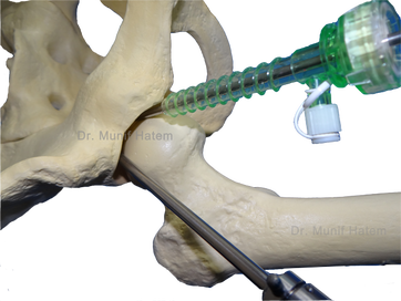 Cânulas na artroscopia do quadril, cirurgia videoartroscópica do quadril, técnica e instrumentos,