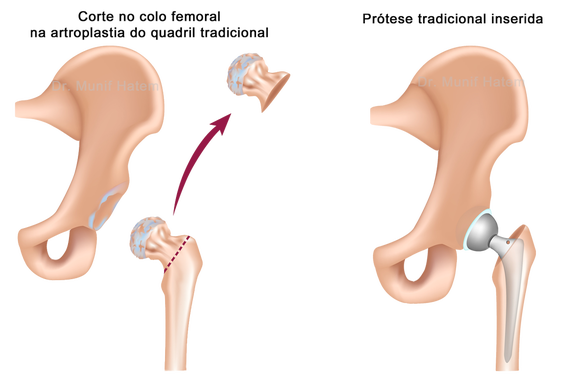 Artroplasia total do quadril corte no fêmur e colocação