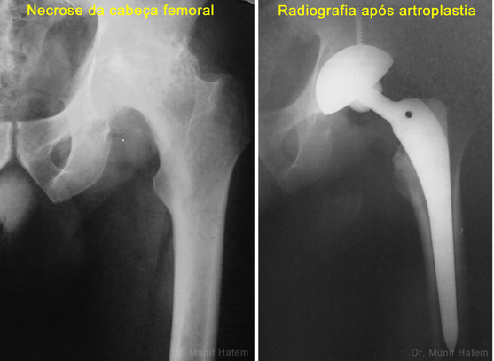 Necrose da cabeça femoral com artrose e raio x após cirurgia de prótese de quadril