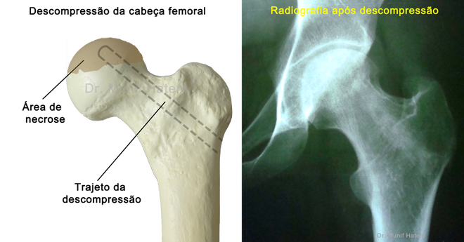 Cirurgia de descompressão da cabeça femoral para necrose do quadril, raio X e como é a cirurgia