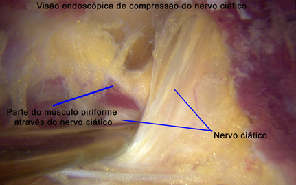 irurgia para síndrome do piriforme e nervo ciático, cirurgia artroscópica