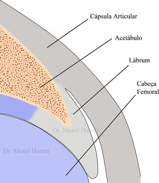 Lábrum do quadril, cápsula e cartilagem, cabeça femoral, Dr. Munif Hatem, 