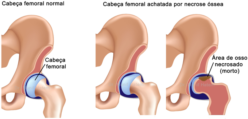 Necrose avascular da cabeça femoral, afundamento e deformação da cartilagem do quadril 