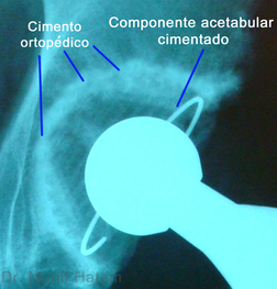raio X de prótese acetabular cimentada no quadril 