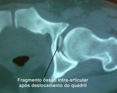 Cirurgia de Videoartroscopia após fratura do acetábulo ou quadril, retirada de fragmento intra-articular 