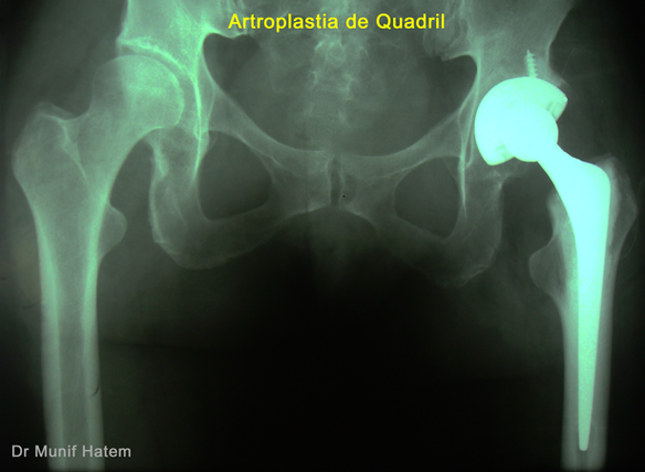 raio x, radiografia de prótese de quadril e cirurgia para fratura de colo femoral