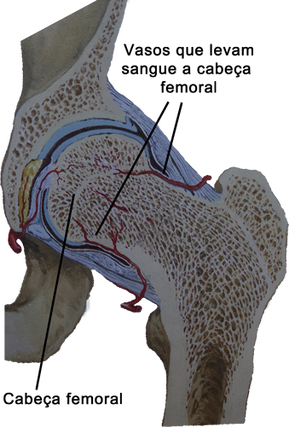 Necrose da cabeça femoral, lesão nas artérias e vasos do colo femoral por trauma e fratura do colo do fêmur