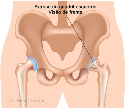 artrose e desgaste do quadril antes da cirurgia de prótese