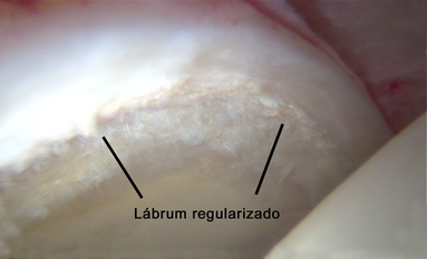 Tratamento das rupturas do lábio acetabular com cirurgia de vídeo-artroscopia 