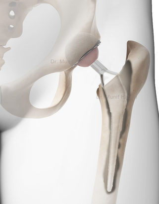 Prótese de quadril frouxa com perda óssea e cirurgia de revisão para correção, complicação em prótese de quadril, Dr. Munif Hatem