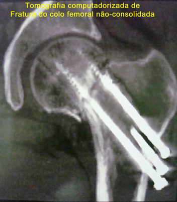 tomografia computadorizada de fratura do colo do fêmur complicada antes da cirurgia 