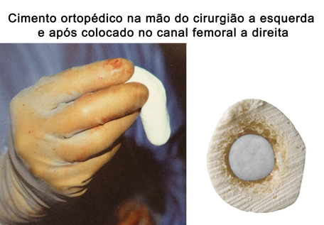 cimento ósseo usado em prótese de quadril 