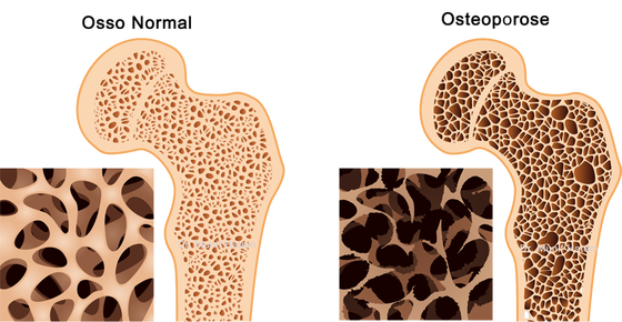 osso normal e osso com osteoporose no quadril e fêmur