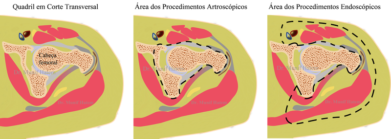 Cirurgias artroscópicas e endoscópicas do quadril, espaço central e periférico, peri trocantérico e glúteo 
