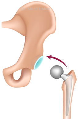 redução da prótese de quadril e testes de estabilidade passos da artroplastia