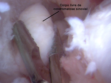 Cirurgia de vídeo-artroscopia do quadril para osteocondromatose com retirada de corpos livres