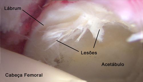 Lesões do lábrum do quadril mostradas e tratadas em vídeo artroscopia 