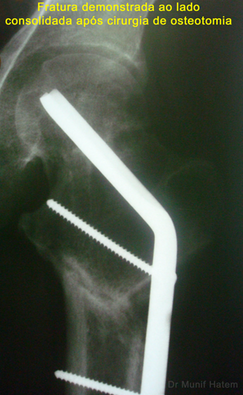 raio X de fratura do colo complicada curada após cirurgia de osteotomia do quadril