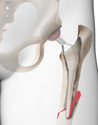 Fratura ao redor da prótese de quadril no fêmur, osso quebrado em prótese do quadril ou artroplastia do quadril. Cirurgia para fratura em prótese do quadril