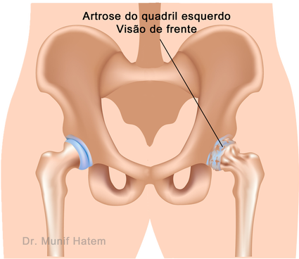 Artrose do quadril e desgaste cirurgia