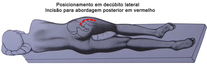 Abordagem posterior para cirurgia de prótese de quadril, mini incisão, corte na bunda, cicatriz