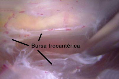 Cirurgia artroscópica ou por vídeo para bursite trocantérica com remoção da Bursa do quadril