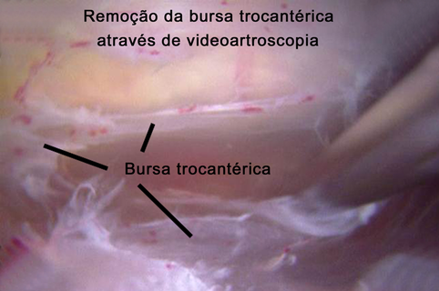 Cirurgia para bursite trocantérica através de vídeo artroscopia, tratamento de bursite do quadril