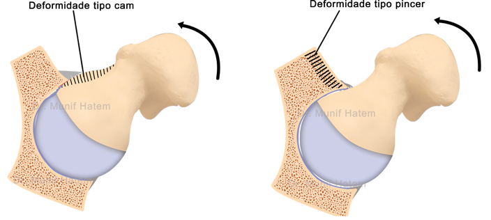 Impacto femoroacetabular no quadril tipo pincer e cam, pinçamento e came do lábrum, lesão do lábio do quadril
