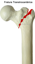 fratura trocantérica do fêmur deslocada e não deslocada por osteoporose