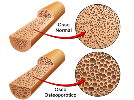 osteoporose e osteopenia quadril, osso fraco com fratura em idoso 