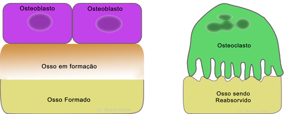 osteoporose e osteopenia quadril, células ósseas osteoblasto e osteoclasto 
