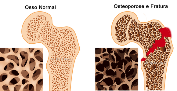 osteoporose e osteopenia com fratura do quadril e fêmur em idosos 